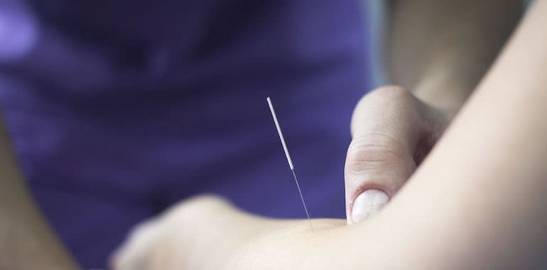 Dry Needling vs Acupuncture